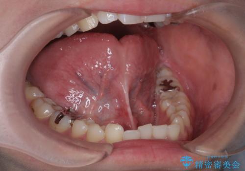 [舌小帯形成術]   ベロが短く食事がしづらいの症例 治療前