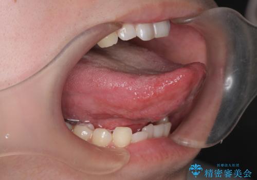 [舌小帯形成術]   ベロが短く食事がしづらいの症例 治療後