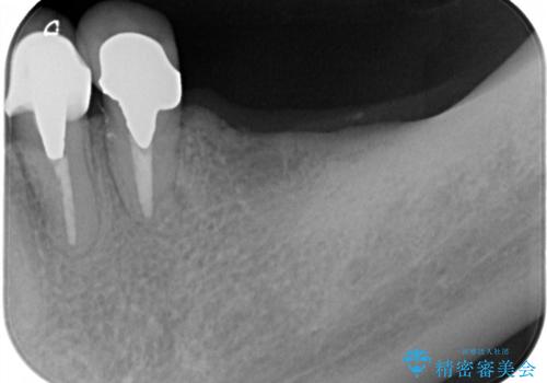 ノンクラスプデンチャー(金属止め具のない入れ歯)で左側の咬合回復の治療前