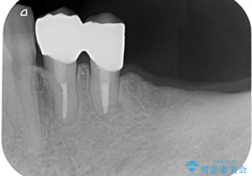 ノンクラスプデンチャー(金属止め具のない入れ歯)で左側の咬合回復の治療後