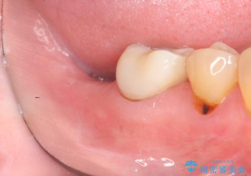 奥歯　インプラントによる機能回復の治療前