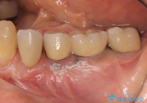 ブリッジ支台の歯の痛み　インプラントによる咬合負担の治療後