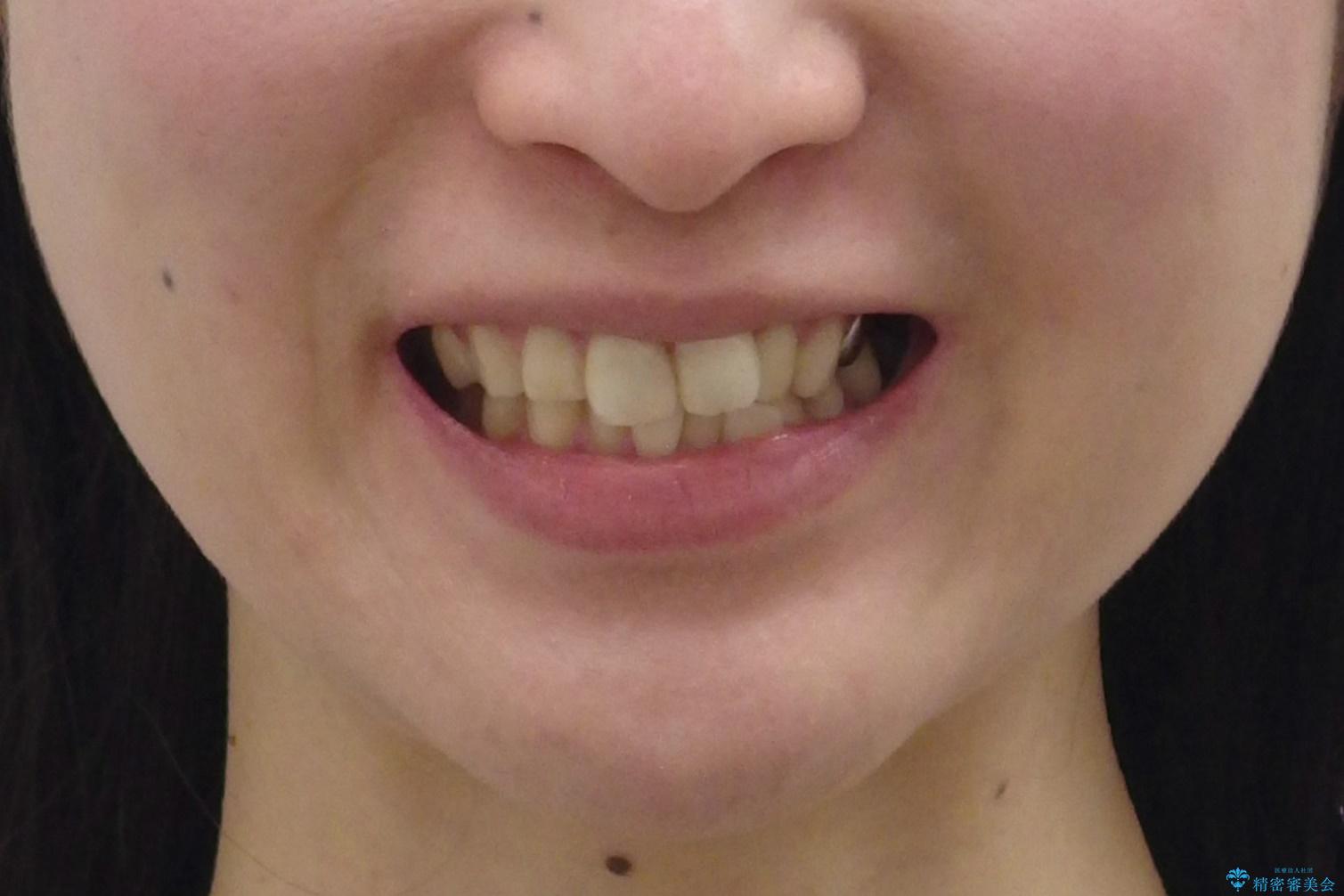 前歯の歯並びが気になる　マウスピース矯正　30代女性の治療前（顔貌）