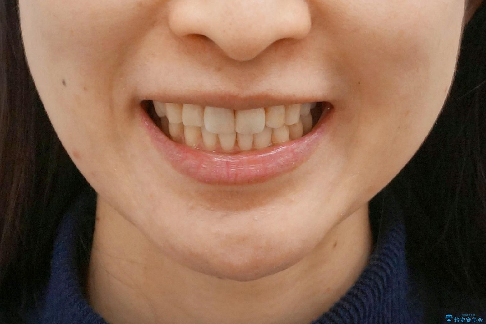 前歯の歯並びが気になる　マウスピース矯正　30代女性の治療後（顔貌）
