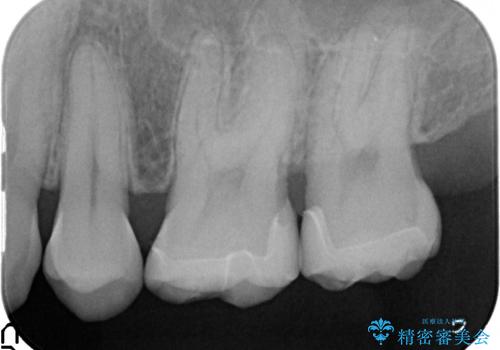 セラミックインレー　銀歯の下の縁下カリエス(歯茎より深い虫歯)の治療の治療後