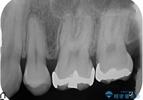 セラミックインレー　銀歯の下の縁下カリエス(歯茎より深い虫歯)の治療の治療前