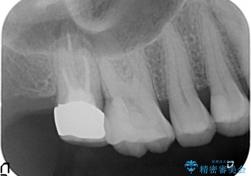 歯髄方向　歯肉方向へと深い 2種類の大きな虫歯の治療後