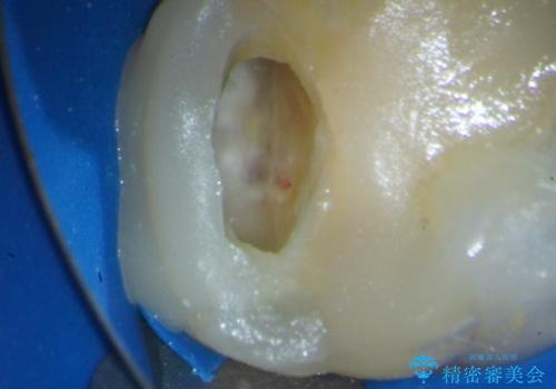 歯髄方向　歯肉方向へと深い 2種類の大きな虫歯の治療前