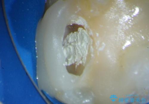 歯髄方向　歯肉方向へと深い 2種類の大きな虫歯の治療中