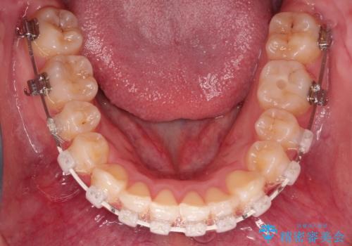 ワイヤーによる抜歯矯正　全体的なガタガタを整った歯並びへの治療中