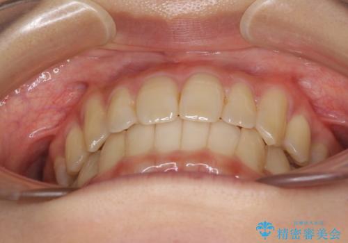 奥歯の反対咬合　上顎骨を拡大してインビザラインで矯正の治療後