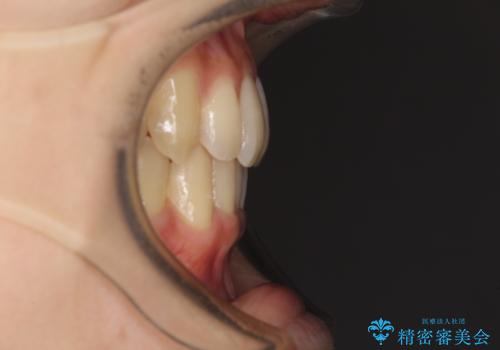 奥歯の反対咬合　上顎骨を拡大してインビザラインで矯正の治療後