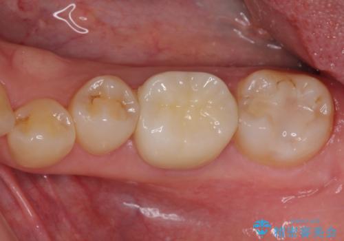 大きな虫歯で歯が欠けた　神経を極力残した治療の治療後