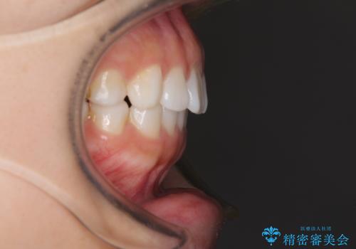 インビザラインによる軽度な出っ歯の矯正治療の治療後