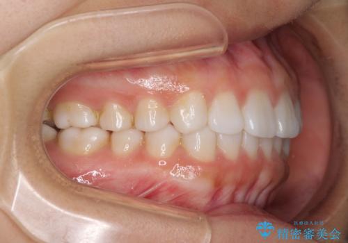 インビザラインによる軽度な出っ歯の矯正治療の治療後