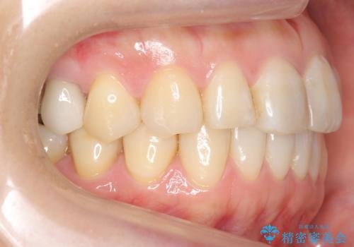 前歯の歯並びが気になる　マウスピース矯正　30代女性の治療後