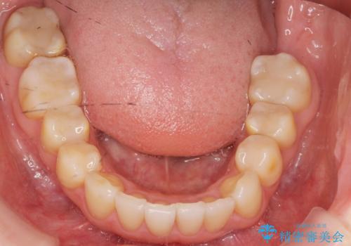 前歯の歯並びが気になる　マウスピース矯正　30代女性の治療後
