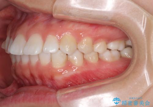 インビザラインによる軽度な出っ歯の矯正治療の治療中
