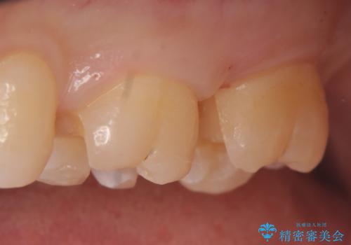 セラミックインレー　銀歯の下の縁下カリエス(歯茎より深い虫歯)の治療の治療中
