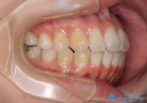 インビザラインで機能面に問題のある歯列を改善の治療中