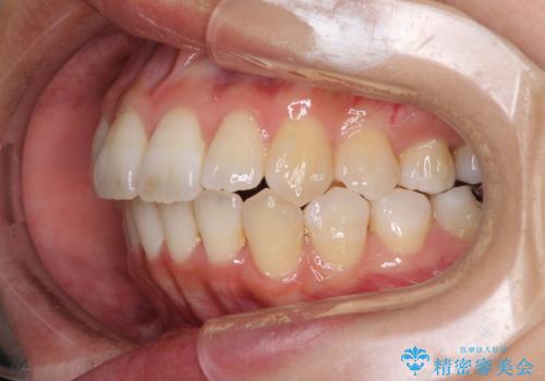 インビザラインで機能面に問題のある歯列を改善の治療中
