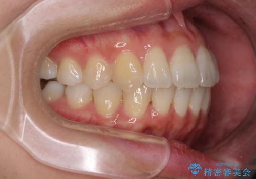 インビザラインで機能面に問題のある歯列を改善の治療後