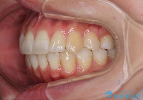 インビザラインで機能面に問題のある歯列を改善の治療後