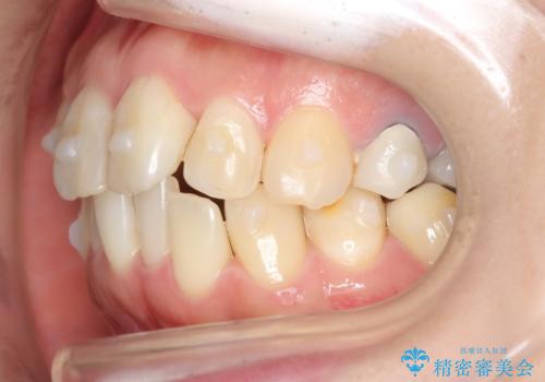 前歯の歯並びが気になる　マウスピース矯正　30代女性の治療中