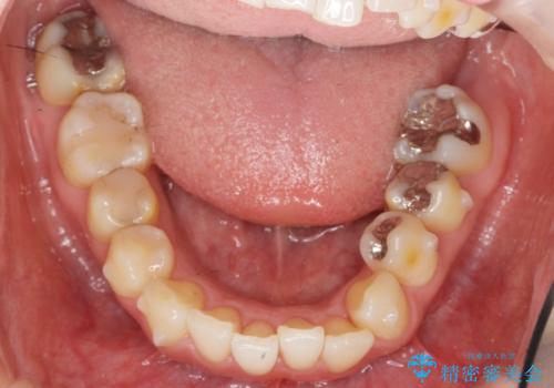 前歯の歯並びが気になる　マウスピース矯正　30代女性の治療中