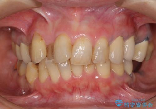 ノンクラスプデンチャー(金属止め具のない入れ歯)で左側の咬合回復の治療前