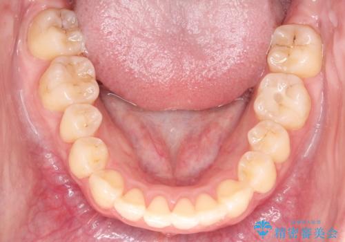 ワイヤーによる抜歯矯正　全体的なガタガタを整った歯並びへの治療後