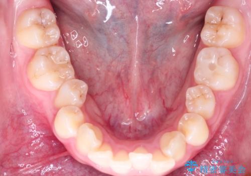 ワイヤーによる抜歯矯正　全体的なガタガタを整った歯並びへの治療前