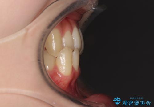 奥歯の反対咬合　上顎骨を拡大してインビザラインで矯正の治療前
