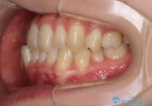奥歯の反対咬合　上顎骨を拡大してインビザラインで矯正の治療前
