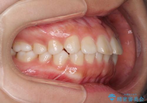 インビザラインによる軽度な出っ歯の矯正治療の治療前
