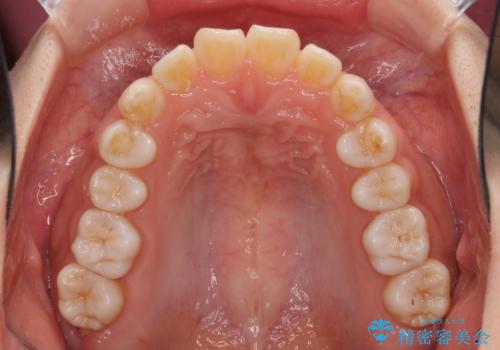 インビザラインによる軽度な出っ歯の矯正治療の治療前