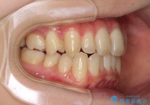 奥歯の反対咬合　上顎骨を拡大してインビザラインで矯正の治療中