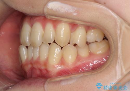 奥歯の反対咬合　上顎骨を拡大してインビザラインで矯正の治療中