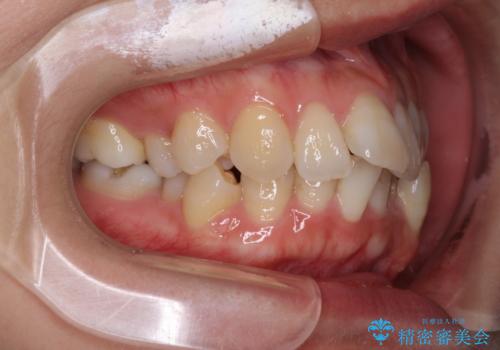 インビザラインで機能面に問題のある歯列を改善の治療前