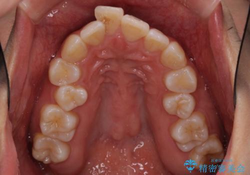 インビザラインで機能面に問題のある歯列を改善の治療前