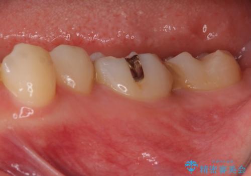 大きな虫歯で歯が欠けた　神経を極力残した治療の治療前