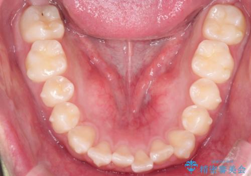 前歯のガタガタを目立たずきれいにしたい　インビザラインによる見えない矯正の治療中