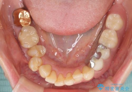 ノンクラスプデンチャー(金属止め具のない入れ歯)で左側の咬合回復の治療後