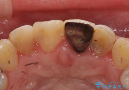 オールセラミッククラウン　前歯を綺麗に　神経が死んだ歯の再治療～補綴の治療前