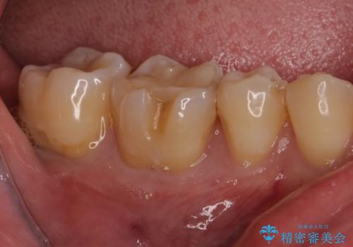 セラミックインレーやりかえ　虫歯の除去をしっかりとの治療前