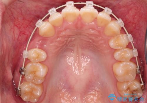 ワイヤーによる抜歯矯正　全体的なガタガタを整った歯並びへの治療中