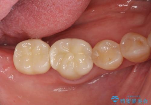 奥歯　インプラントによる機能回復の治療後