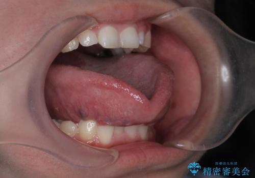[舌小帯形成術]   ベロが短く食事がしづらいの治療前