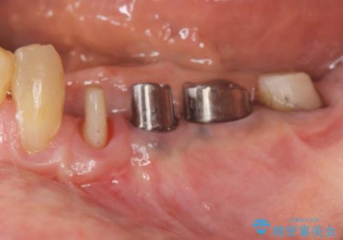 ブリッジ支台の歯の痛み　インプラントによる咬合負担の治療中
