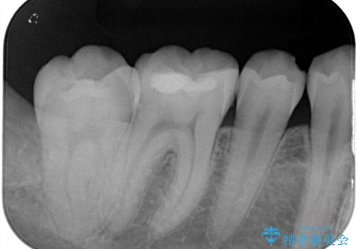 セラミックインレーやりかえ　虫歯の除去をしっかりとの治療後